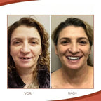 Snap On Veneers Custom Fit - Image 5
